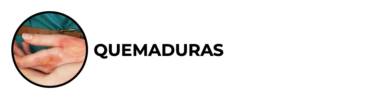 Quemaduras